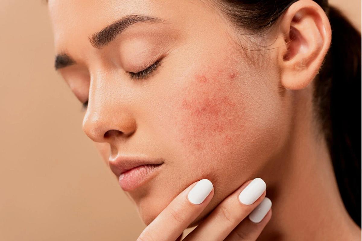 Dermatoloq məşhur mifi dağıtdı: Sızanaqların səbəbi qidalanma deyil